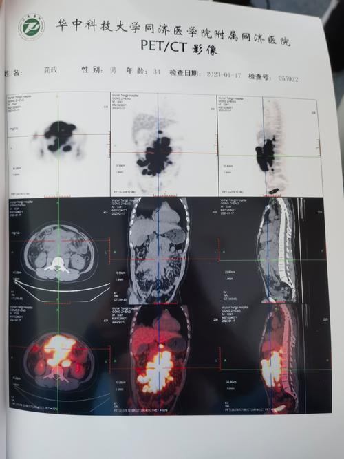 什么是PED,什么是pEDCT