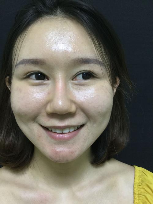 嘴巴打一支玻尿酸多吗,嘴巴打玻尿酸有什么副作用